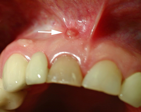 Através da fístula localizada na gengiva acima do dente, o pus é evacuado para a cavidade oral.