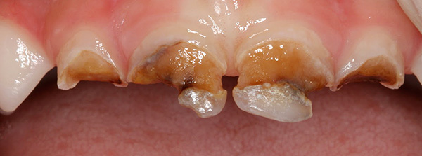 A falta de tratamento oportuno da cárie de dentes decíduos em uma criança pode causar sérios danos à saúde do bebê como um todo.