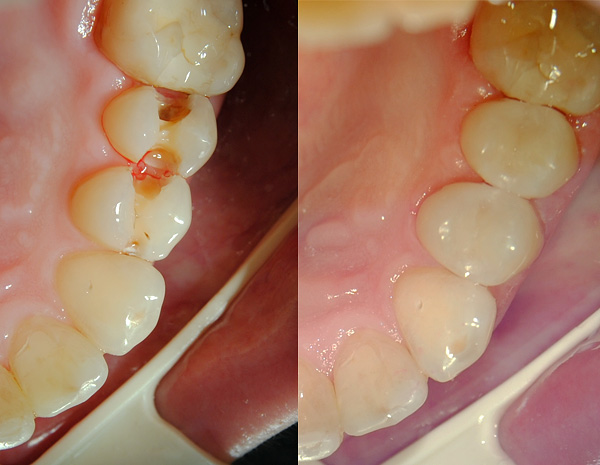 O material de enchimento é visualmente praticamente indistinguível dos tecidos naturais dos dentes.