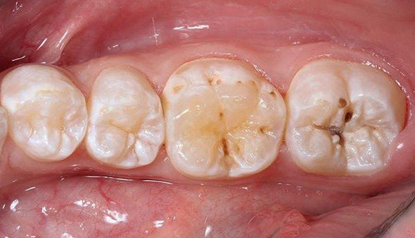 As fissuras dos dentes de mastigação são freqüentemente afetadas por cáries, pois há acúmulo de resíduos alimentares.