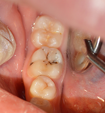 Processo carioso na área da fissura do dente de mastigação inferior.