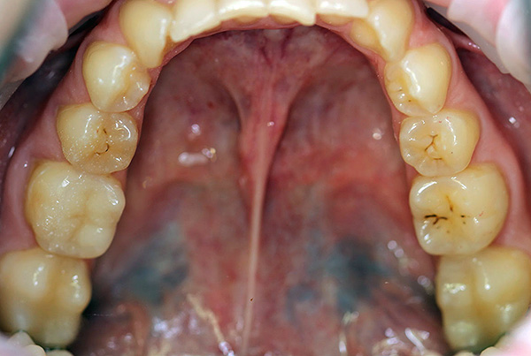 A taxa de cárie dentária devido ao processo de cárie é diferente para todas as pessoas e depende de muitos fatores, incluindo as características individuais do corpo.