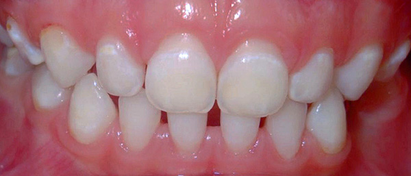 Manchas brancas são áreas de desmineralização do esmalte dos dentes.