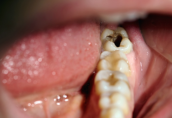 Cárie profunda do dente de mastigação inferior.