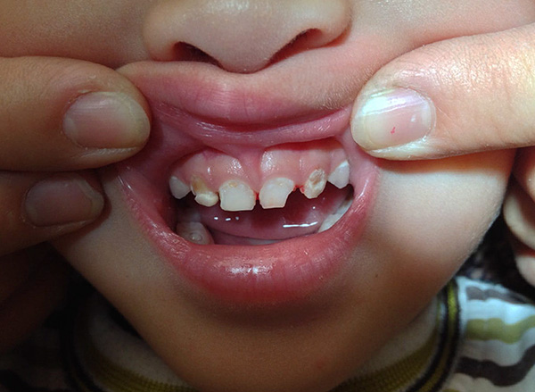 Sobre maneiras de aliviar a dor de dente em crianças ...