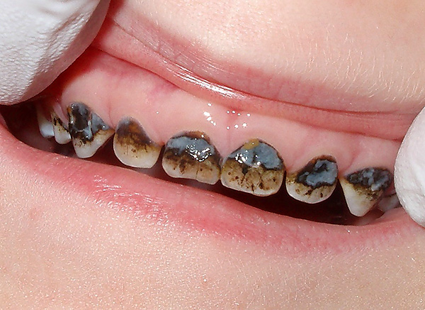 Os efeitos do prateamento dentário
