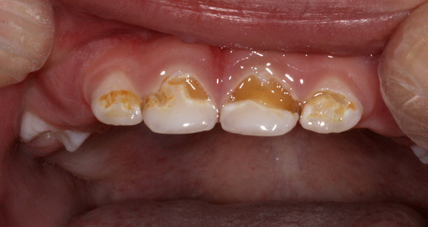 Com danos profundos no esmalte, uma variedade de substâncias irritantes pode causar dor de dente grave: química, temperatura e mecânica.