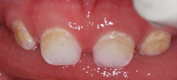 Cárie de dentes decíduos na fase de um ponto branco (giz).