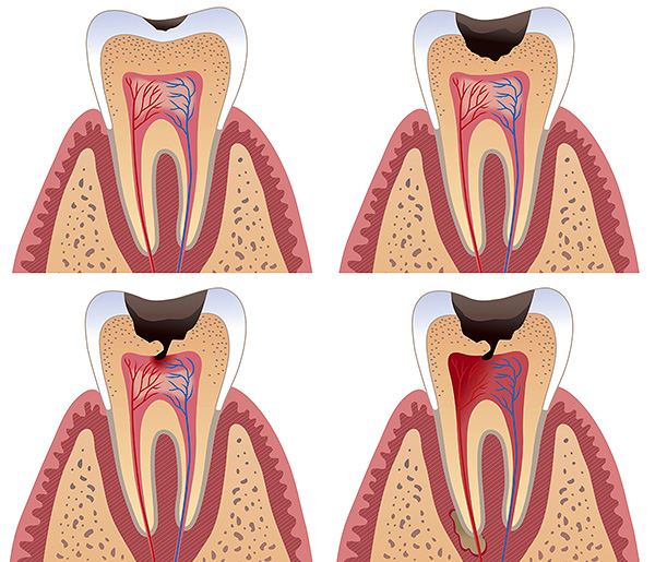 Quanto mais tempo você adiar uma visita ao dentista, será necessário um tratamento mais complexo e demorado.