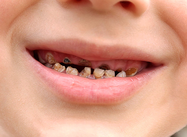 Se você não monitorar a condição dos dentes no bebê, ele pode formar complexos psicológicos, que às vezes persistem por muitos anos.