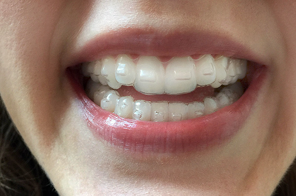 Os marcadores nos dentes, embora perceptíveis, não são muito visíveis.