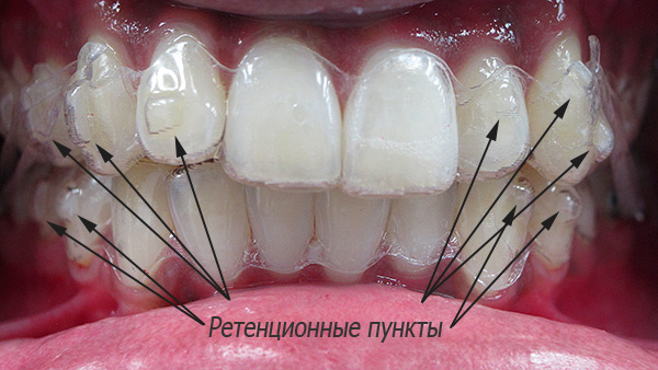 Pontos de retenção nos dentes
