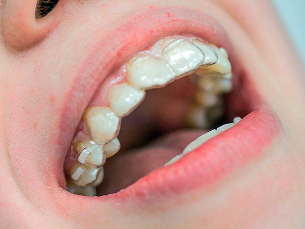 Esse protetor bucal pode ser feito pelo próprio médico para corrigir a posição de um ou mais dentes ...