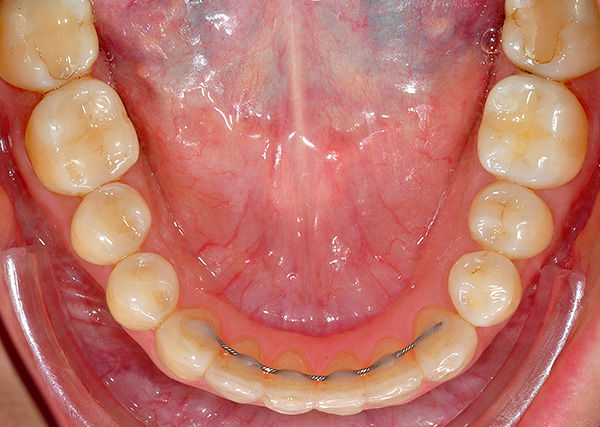 Retentor nos dentes da frente do maxilar inferior.