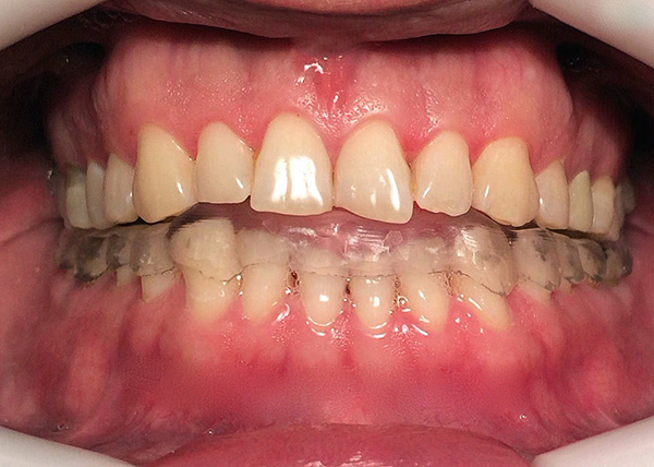 A foto mostra um exemplo de um pneu que quebra os dentes.