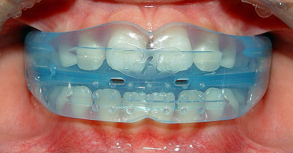 Esse dispositivo é um protetor bucal de silicone macio, que permite corrigir a mordida devido ao desgaste regular.