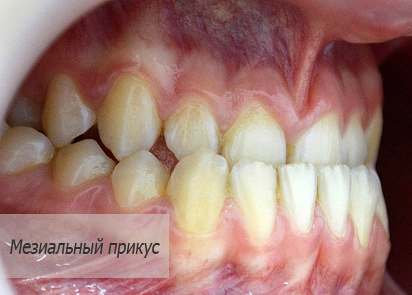 Mordida mesial