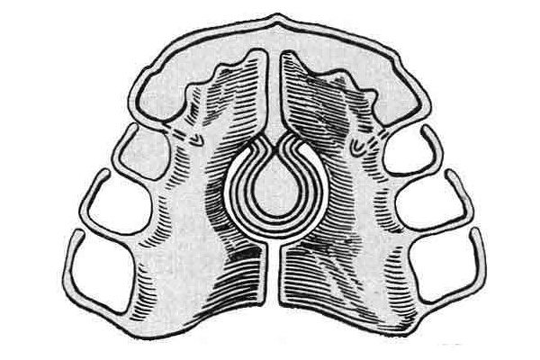Placa com molas para expandir a mandíbula superior.