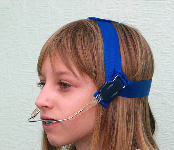 O arco facial é um dispositivo muito simples, mas muito eficaz para corrigir a mordida.