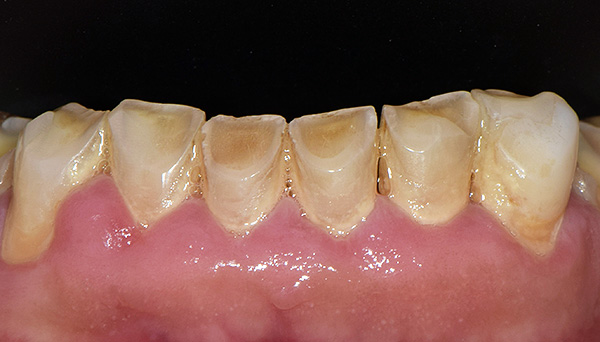 L'occlusione errata ha provocato l'abrasione patologica degli incisivi e delle zanne inferiori.