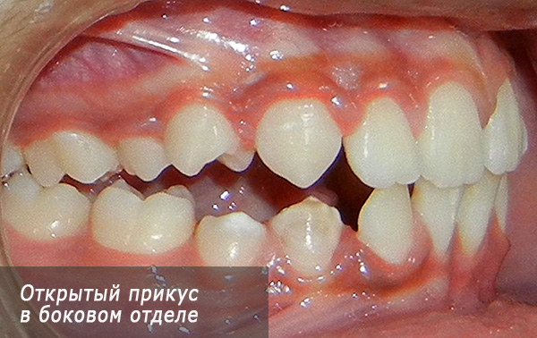 Morso aperto nella dentatura laterale.