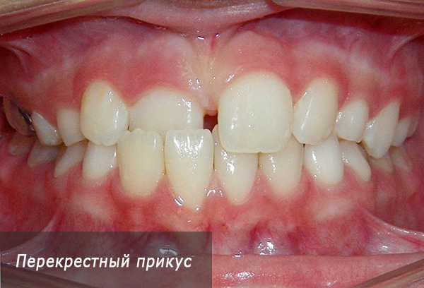 Morso incrociato di denti permanenti.