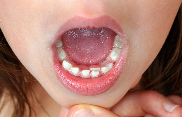 Quando si cambiano i denti da latte in denti permanenti, spesso si possono già vedere segni di futuri problemi con un morso ...