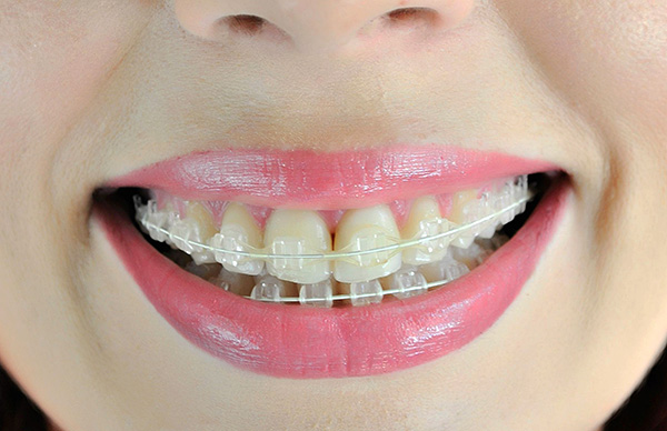 Le parentesi graffe in zaffiro, rispetto al metallo, sono relativamente invisibili sui denti.