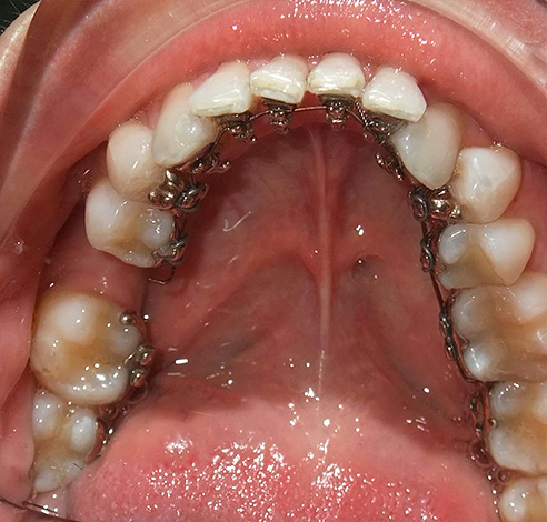 Bretelle linguali 3D realizzate individualmente.
