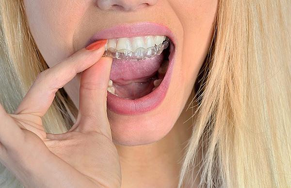 Ecco come un bocchino ortodontico cerca di allineare il morso dei denti permanenti.