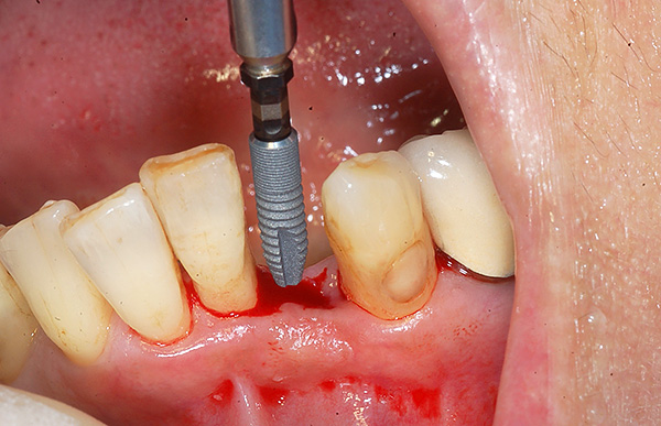 Con la perdita di un dente, l'opzione migliore per le protesi è di solito l'impianto dentale.