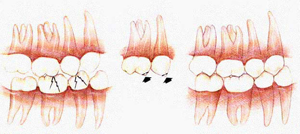 L'eliminazione del blocco dei contatti dentali.