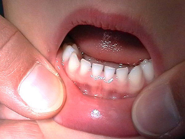 Gli ampi spazi tra i denti da latte non sono una patologia.