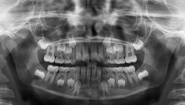 Ecco come appaiono i rudimenti dei denti permanenti in una radiografia.