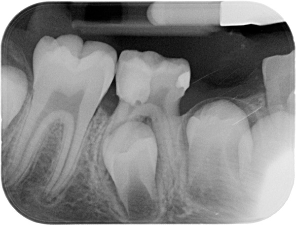 La mineralizzazione dei tessuti inizia il rudimento di un dente permanente nei primi mesi di vita di un bambino.