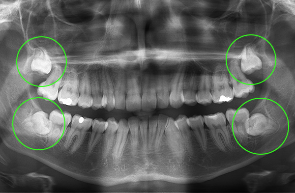 I denti del giudizio sono evidenziati nell'immagine - è chiaro che quelli inferiori non sono nel modo migliore.