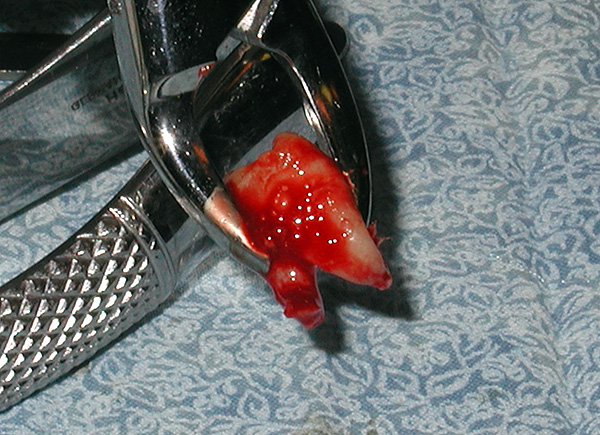 Spesso con il trattamento ortodontico, è necessario rimuovere gli otto.