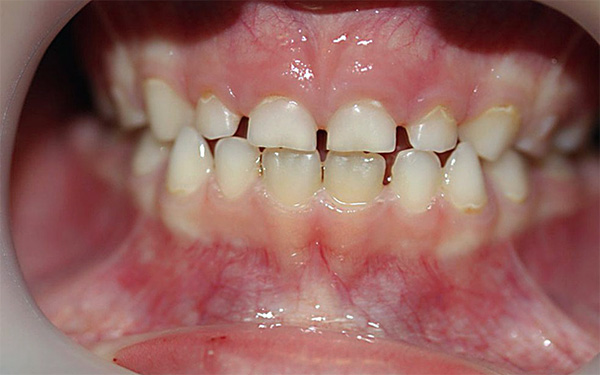 Ad un certo punto, i denti da latte possono subire una significativa abrasione fisiologica.
