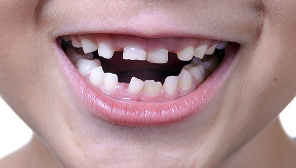 Durante il periodo di cambio dei denti da latte per un morso permanente, il bambino potrebbe essere tutt'altro che ideale.