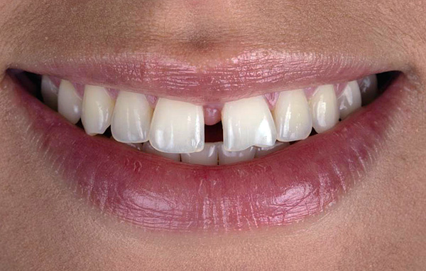 diastema