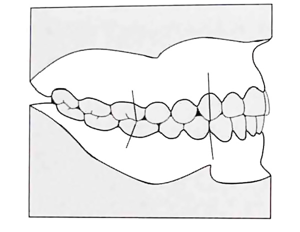 Chiusura ad angolo della dentatura I