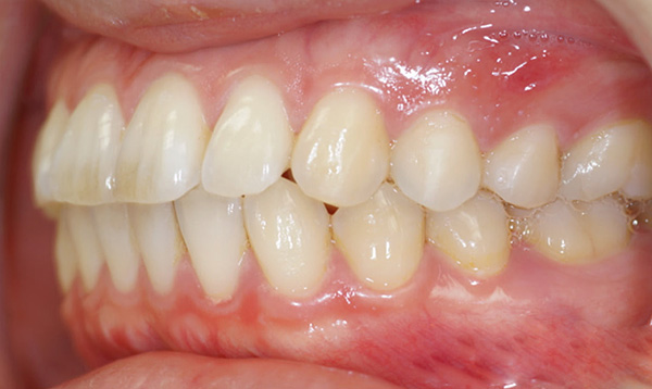 Con un morso biprognatico, i denti anteriori superiore e inferiore sono fortemente inclinati in avanti.