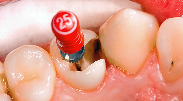 Vamos tentar descobrir por que, depois de tratar a pulpite, um dente ainda pode doer por um longo tempo ...