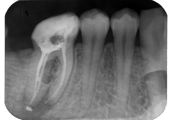 A saída do material de preenchimento além do ápice da raiz do dente pode levar a dores pós-preenchimento prolongadas.