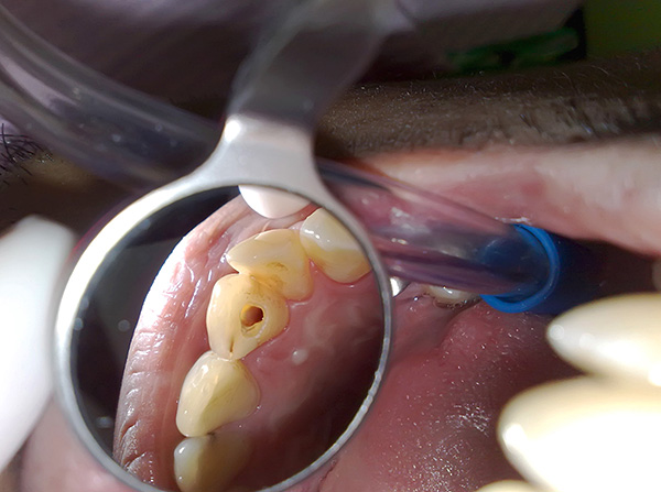 Em alguns casos, a dor ao morder um dente é tão forte que é quase impossível mastigar um lado da mandíbula.
