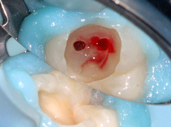 O tratamento dos canais dentários é um procedimento bastante traumático.