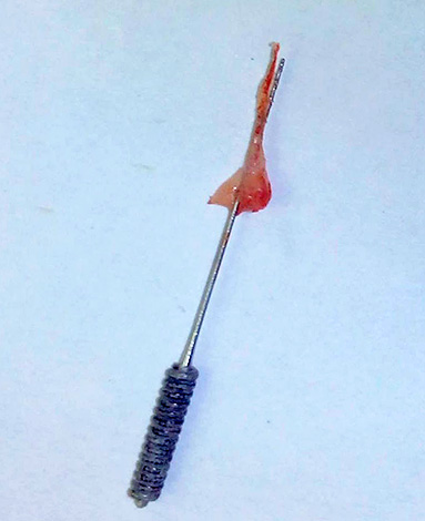 A fotografia mostra a polpa removida do canal dental.