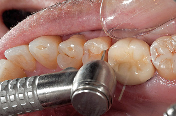 Ao tratar um dente com uma broca, há um forte aquecimento do esmalte, dentina e do próprio boro rotativo.