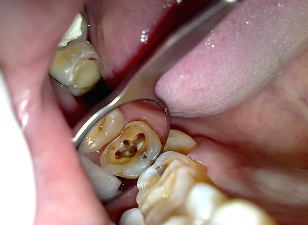 É assim que fica a boca dos canais radiculares do dente de mascar.