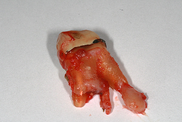 Erros no tratamento da pulpite podem levar à formação de cistos nas raízes do dente.